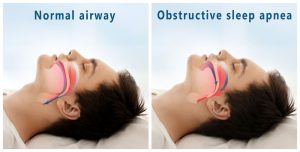 a guy sleeping showing the different types of sleep apnea
